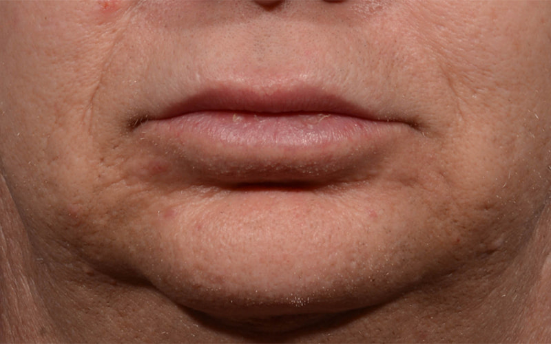 Lip Lift Before & After Image