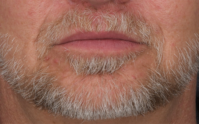 Lip Lift Before & After Image