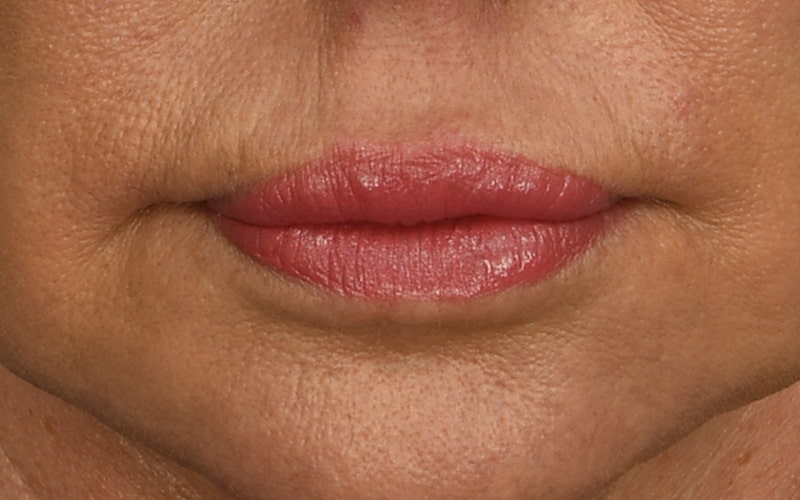 Lip Lift Before & After Image