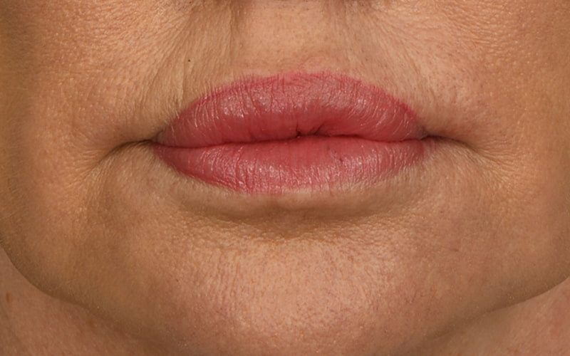 Lip Lift Before & After Image