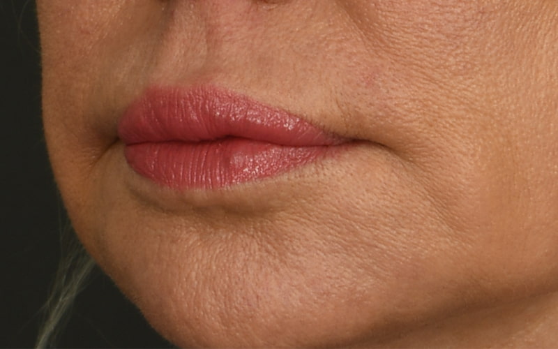 Lip Lift Before & After Image