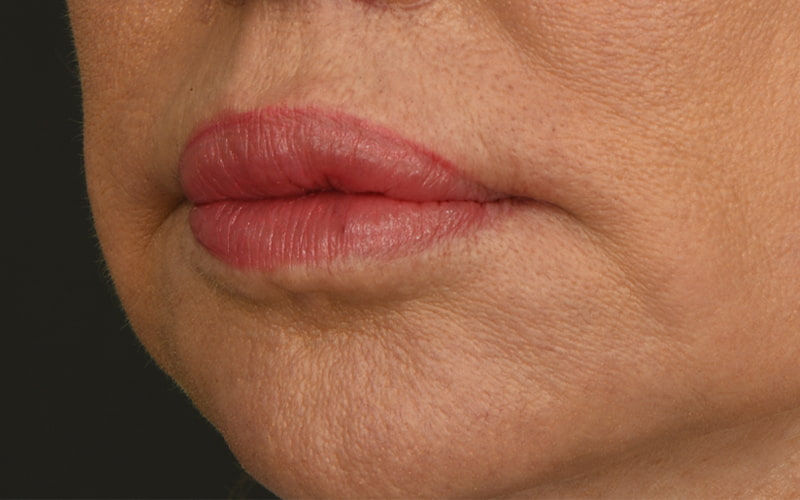 Lip Lift Before & After Image