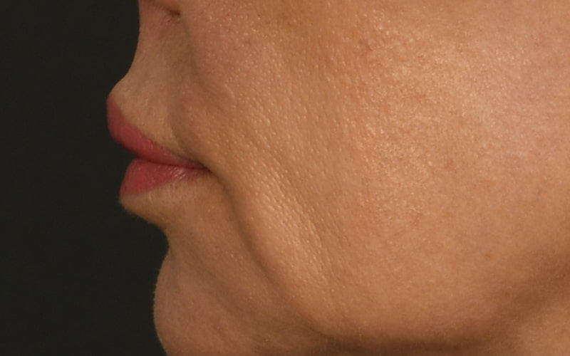 Lip Lift Before & After Image