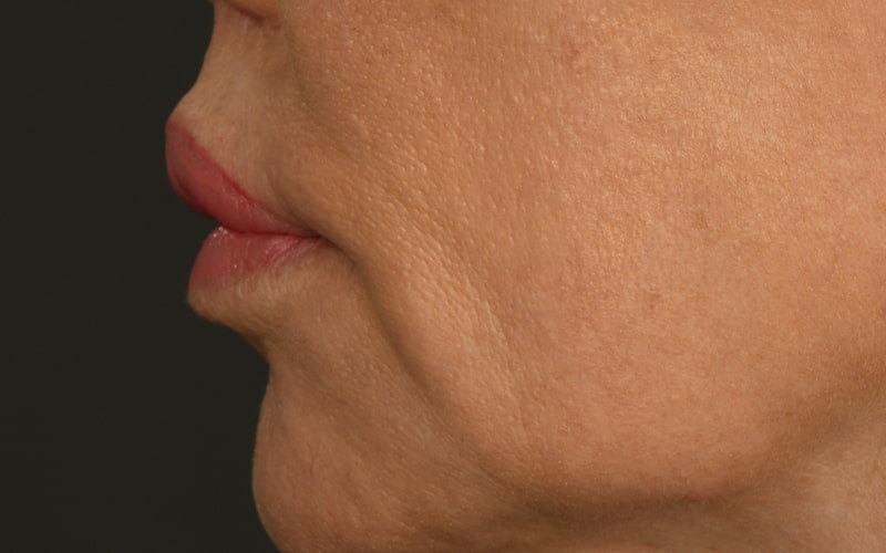 Lip Lift Before & After Image