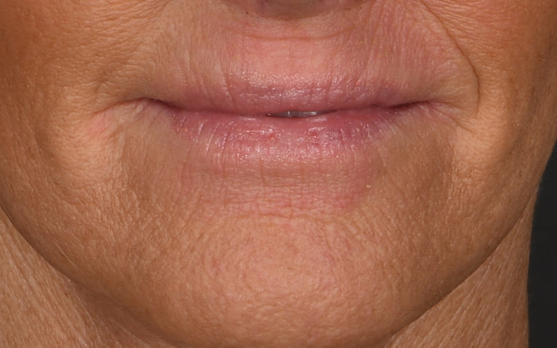 Lip Lift Before & After Image