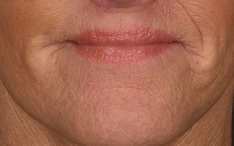 Lip Lift Before & After Image