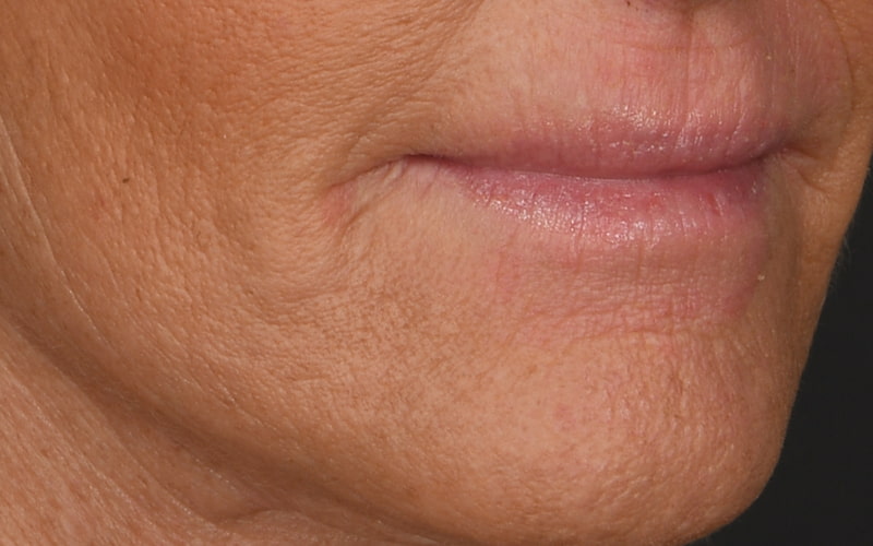 Lip Lift Before & After Image