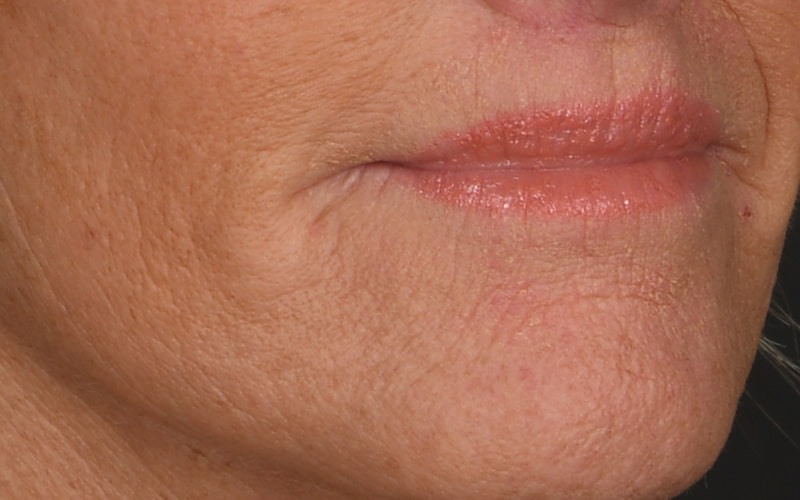 Lip Lift Before & After Image