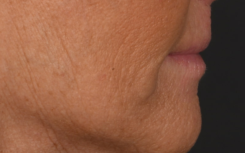 Lip Lift Before & After Image