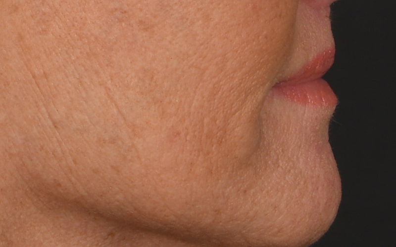 Lip Lift Before & After Image