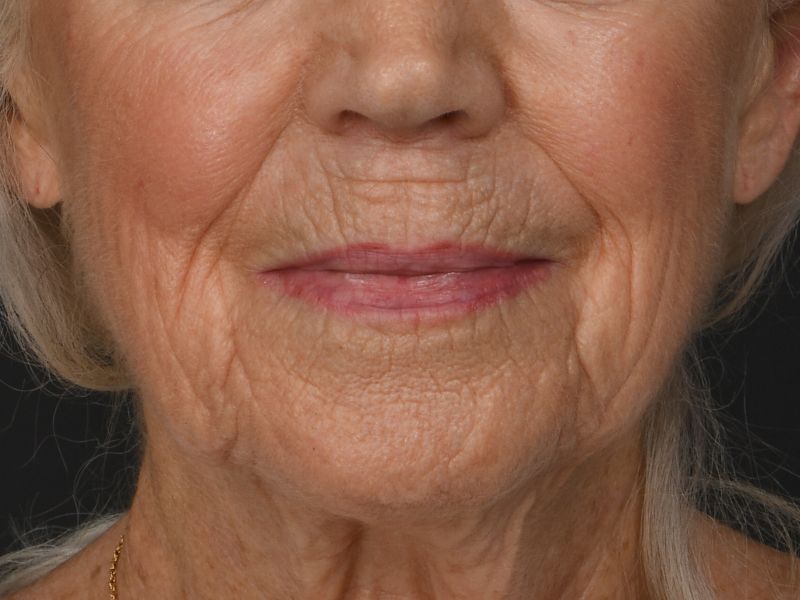 Lip Lift Before & After Image