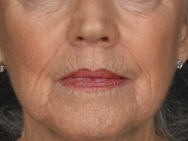 Lip Lift Before & After Image