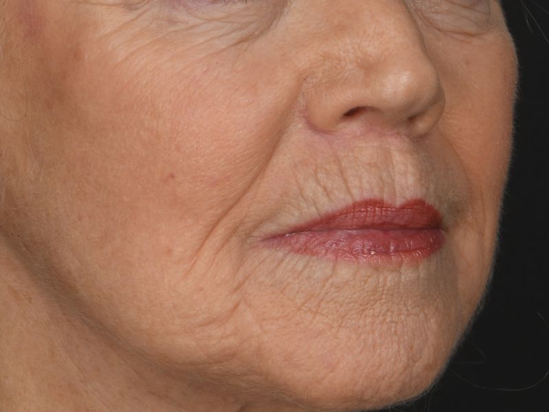 Lip Lift Before & After Image