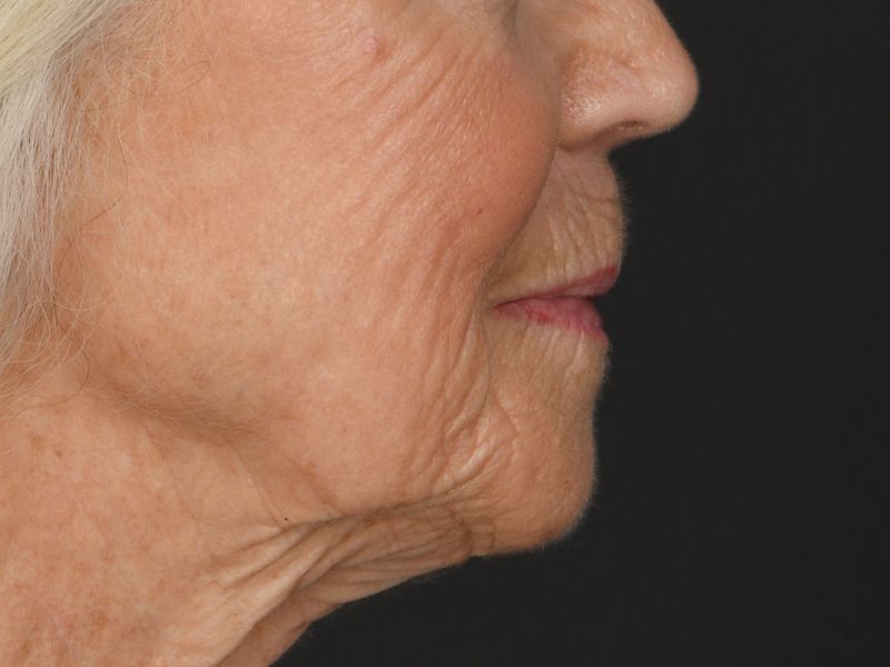 Lip Lift Before & After Image