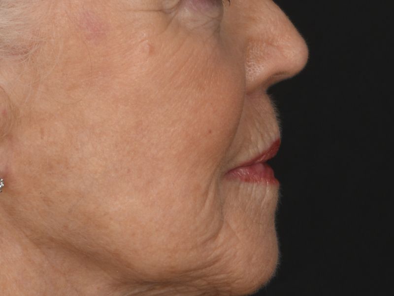 Lip Lift Before & After Image