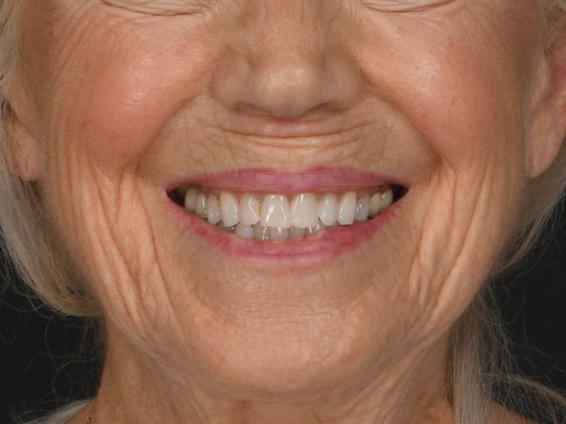 Lip Lift Before & After Image