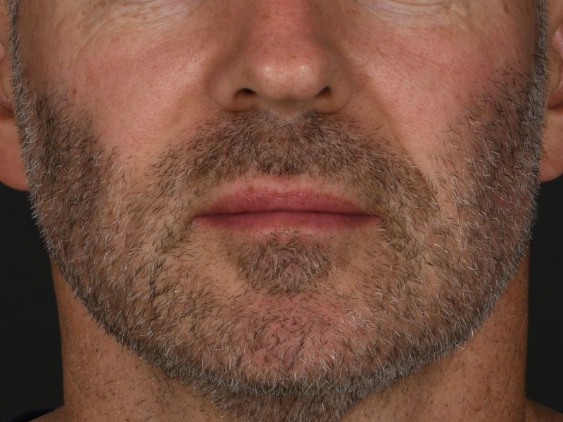 Lip Lift Before & After Image