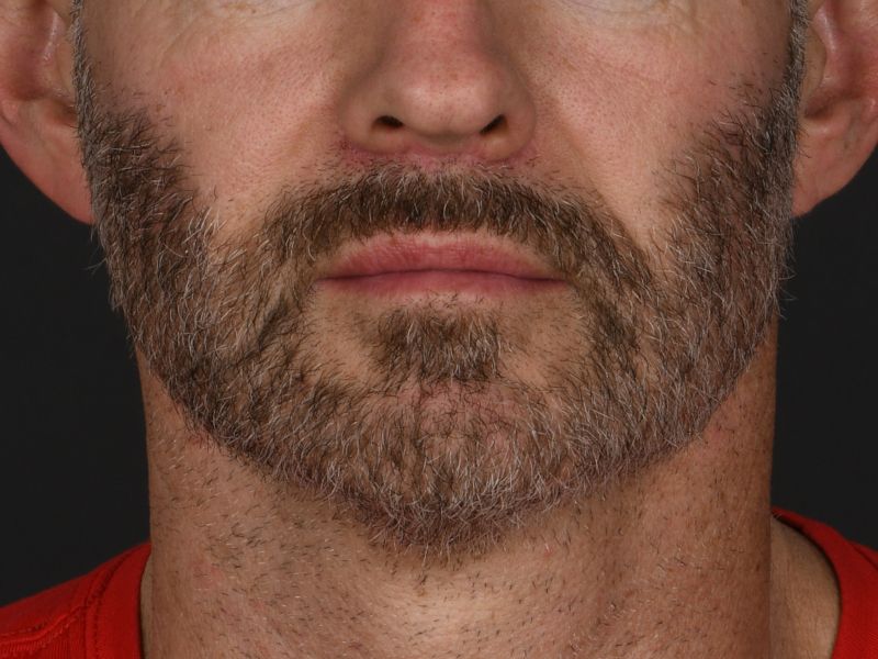 Lip Lift Before & After Image