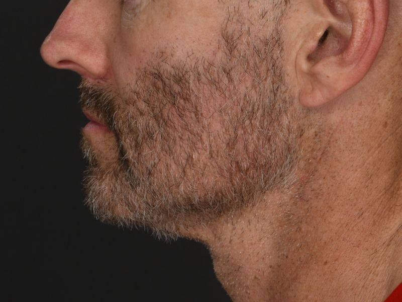 Lip Lift Before & After Image