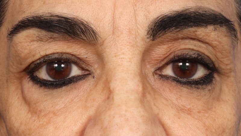 Lower Blepharoplasty Before & After Image