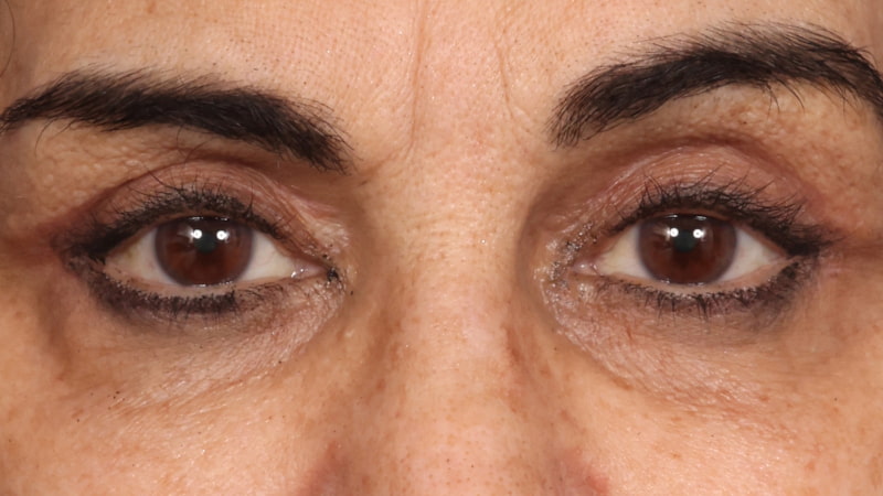 Lower Blepharoplasty Before & After Image