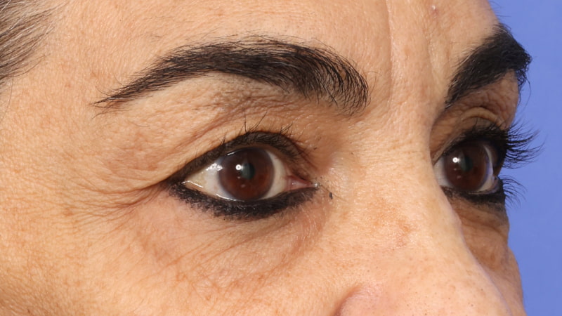 Lower Blepharoplasty Before & After Image