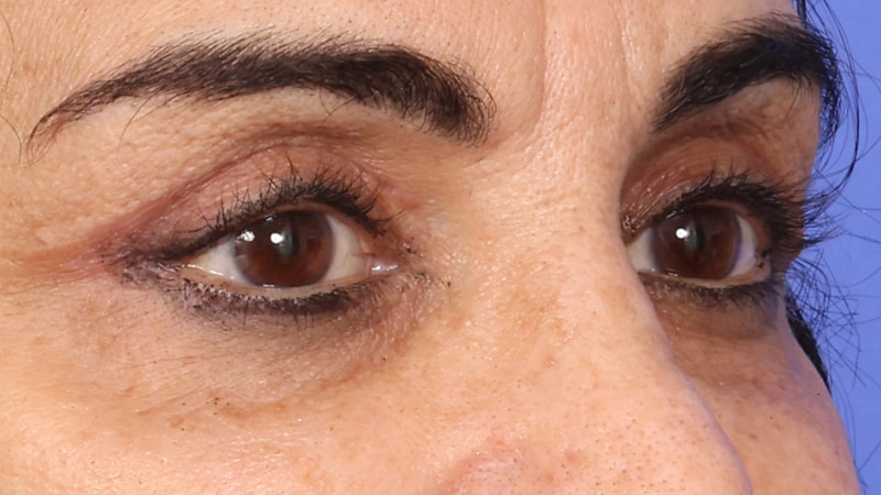 Lower Blepharoplasty Before & After Image