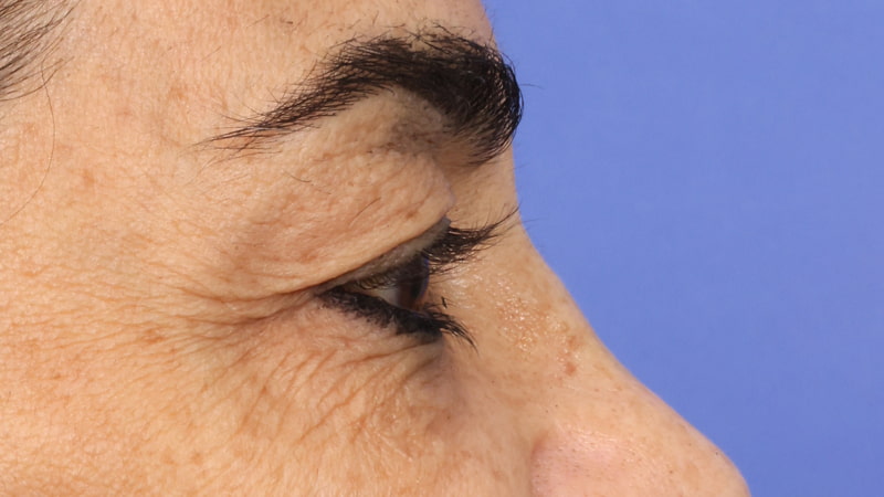 Lower Blepharoplasty Before & After Image