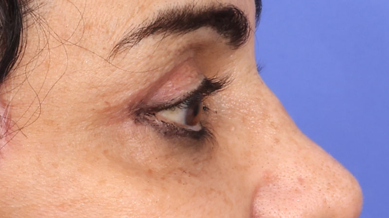 Lower Blepharoplasty Before & After Image