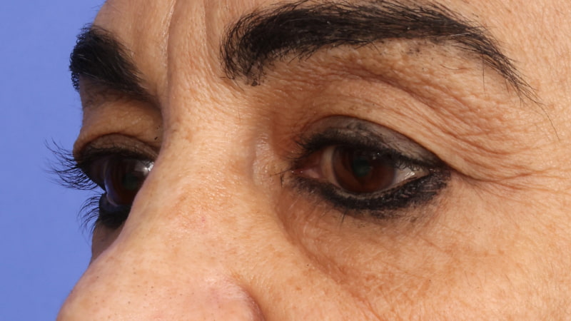 Lower Blepharoplasty Before & After Image