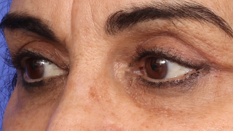 Lower Blepharoplasty Before & After Image