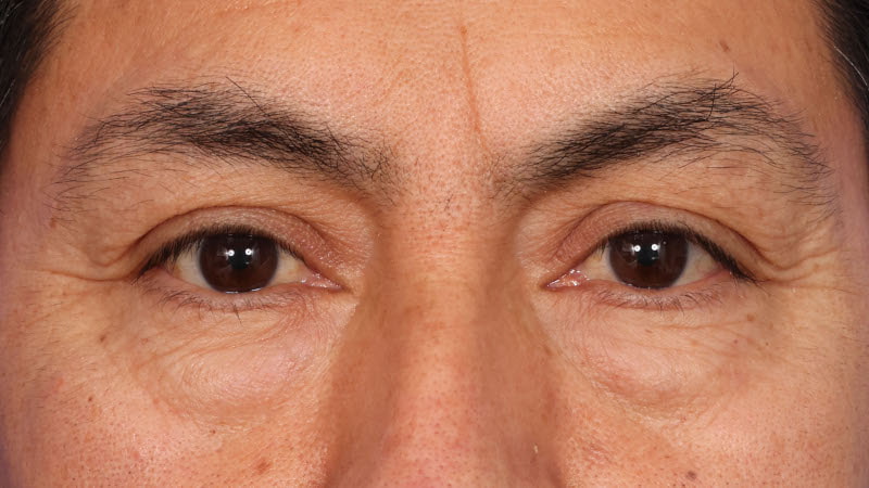 Lower Blepharoplasty Before & After Image