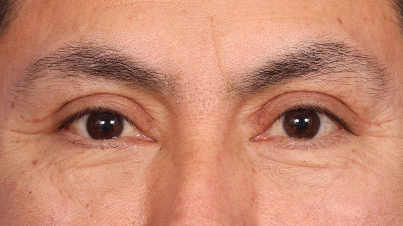 Lower Blepharoplasty Before & After Image