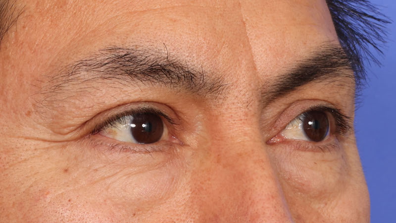 Lower Blepharoplasty Before & After Image