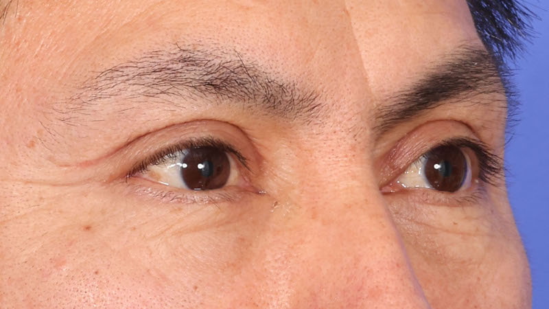 Lower Blepharoplasty Before & After Image