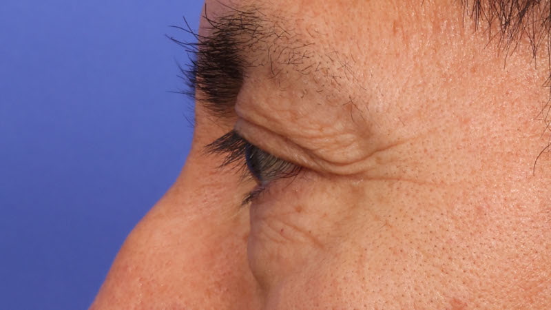 Lower Blepharoplasty Before & After Image