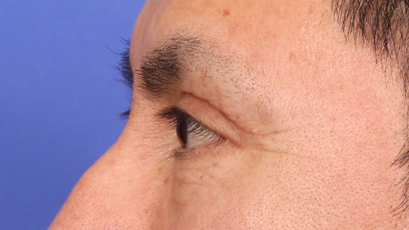 Lower Blepharoplasty Before & After Image