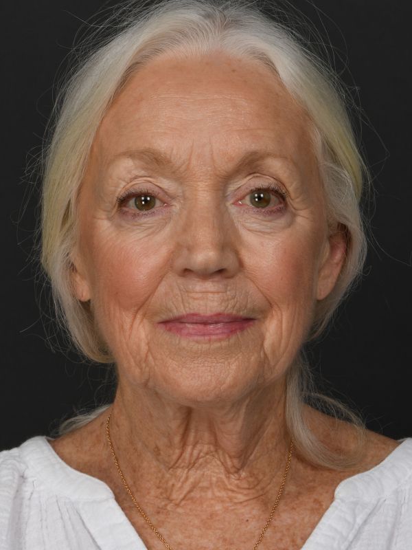 Mini Face & Necklift Before & After Image