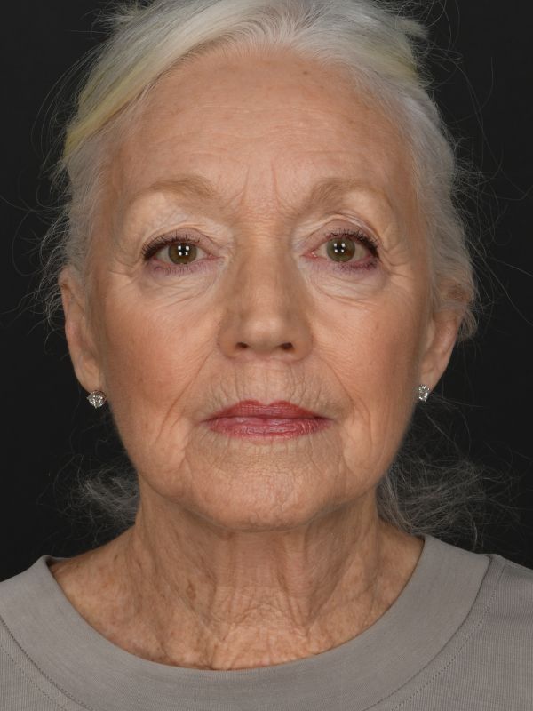 Mini Face & Necklift Before & After Image