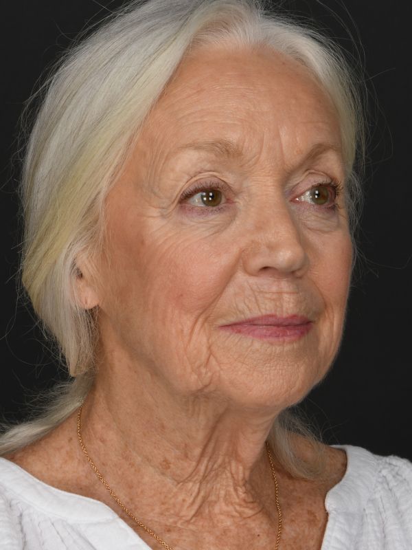 Mini Face & Necklift Before & After Image