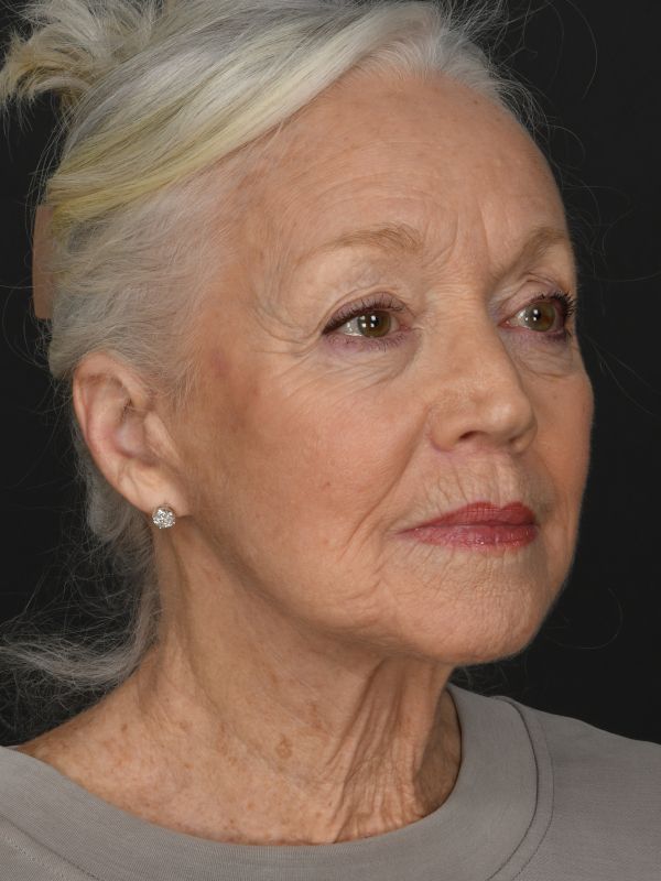 Mini Face & Necklift Before & After Image
