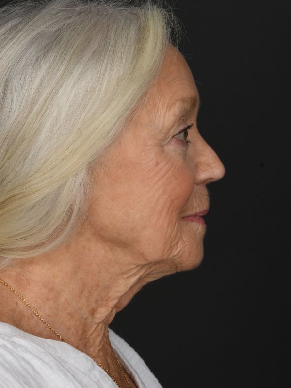 Mini Face & Necklift Before & After Image