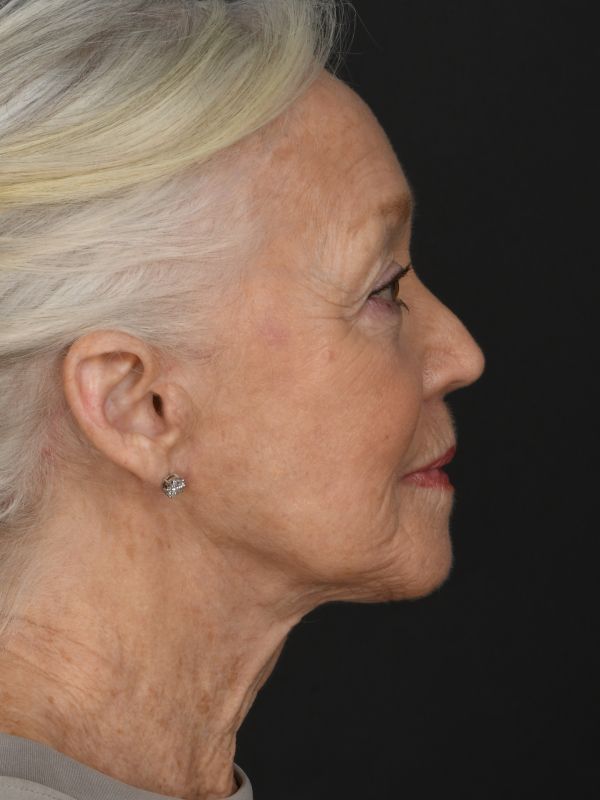 Mini Face & Necklift Before & After Image