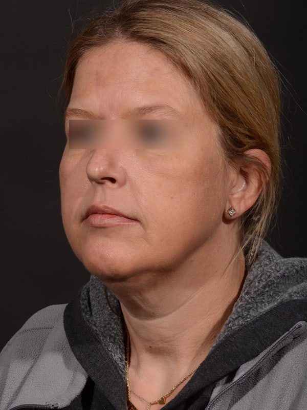 MyEllevate Before & After Image