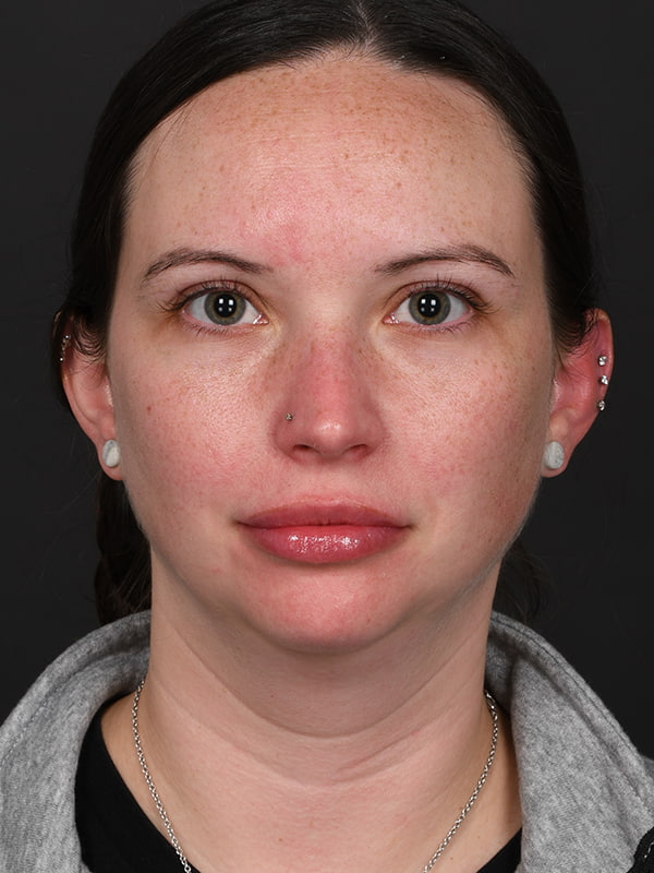 MyEllevate Before & After Image