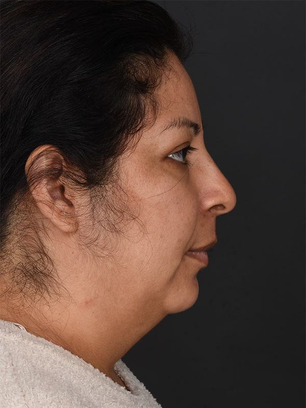 MyEllevate Before & After Image