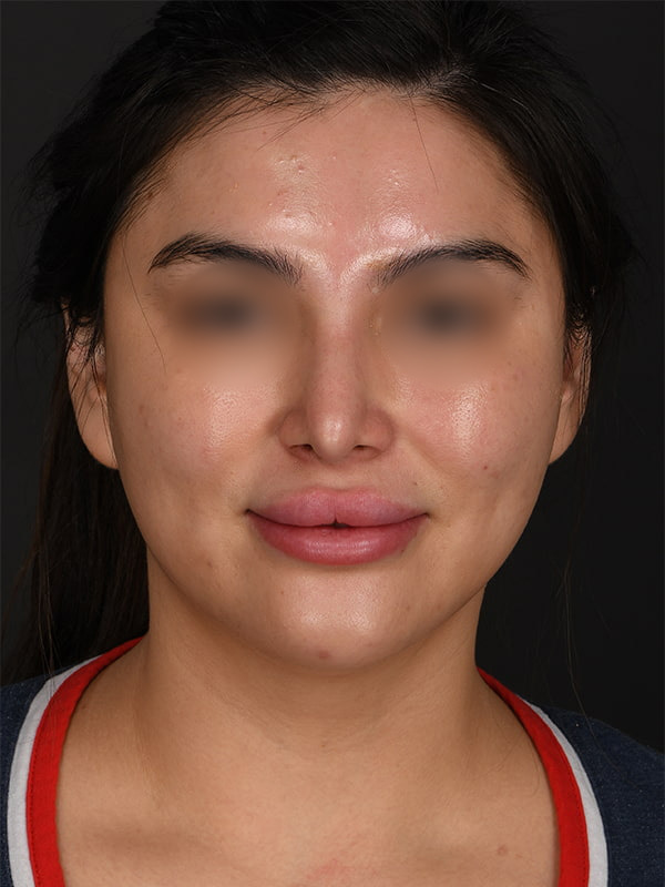 MyEllevate Before & After Image