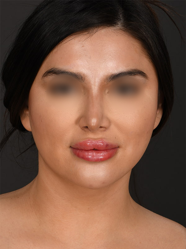 MyEllevate Before & After Image