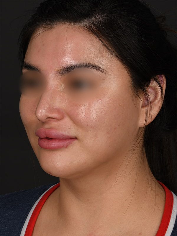 MyEllevate Before & After Image