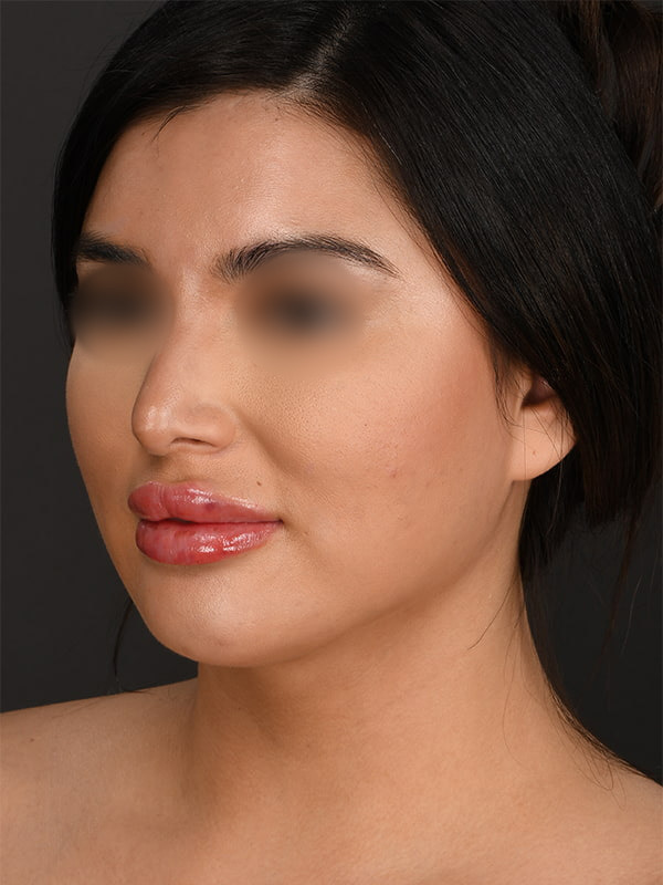 MyEllevate Before & After Image